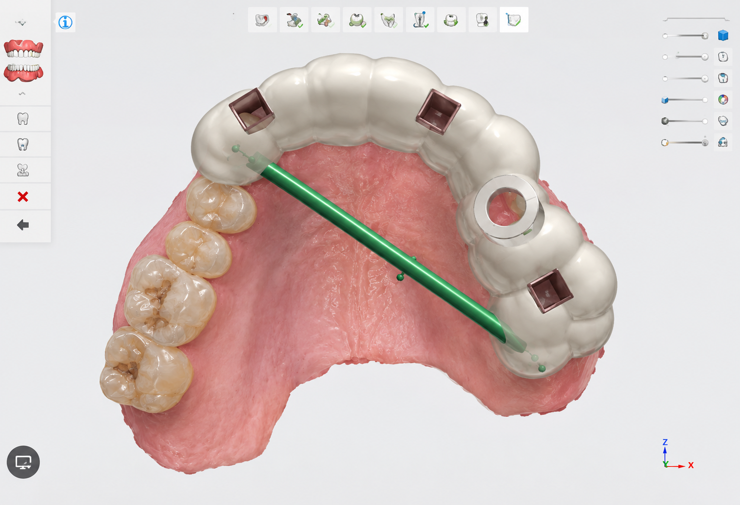 선유도역 치과 연세초록빛 가이드 임플란트 CBCT 3D 계획 01